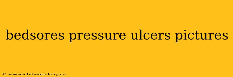 bedsores pressure ulcers pictures