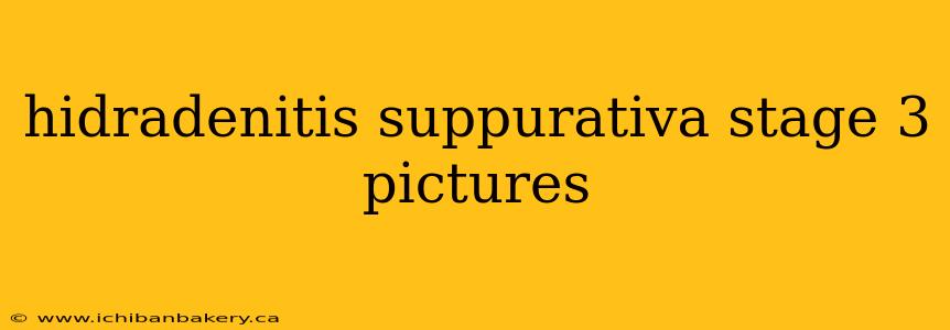 hidradenitis suppurativa stage 3 pictures