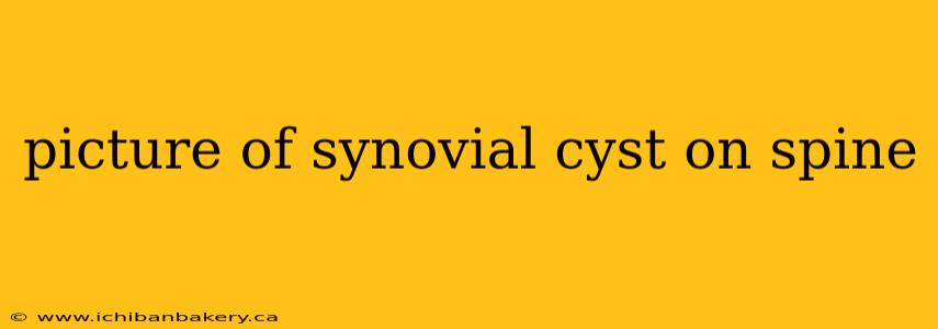 picture of synovial cyst on spine