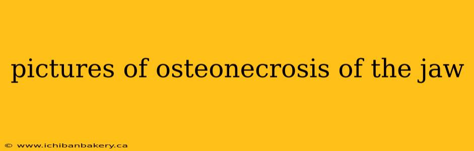 pictures of osteonecrosis of the jaw