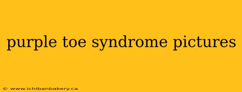 purple toe syndrome pictures